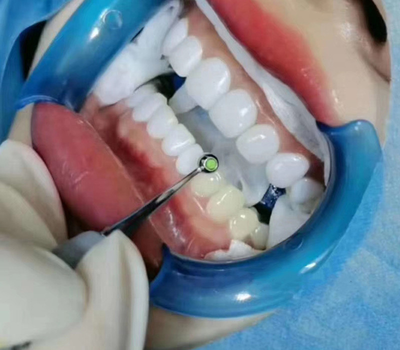 Espátula de relleno de resina  - Teeth Whitening Foam Toothpaste reseña y precio