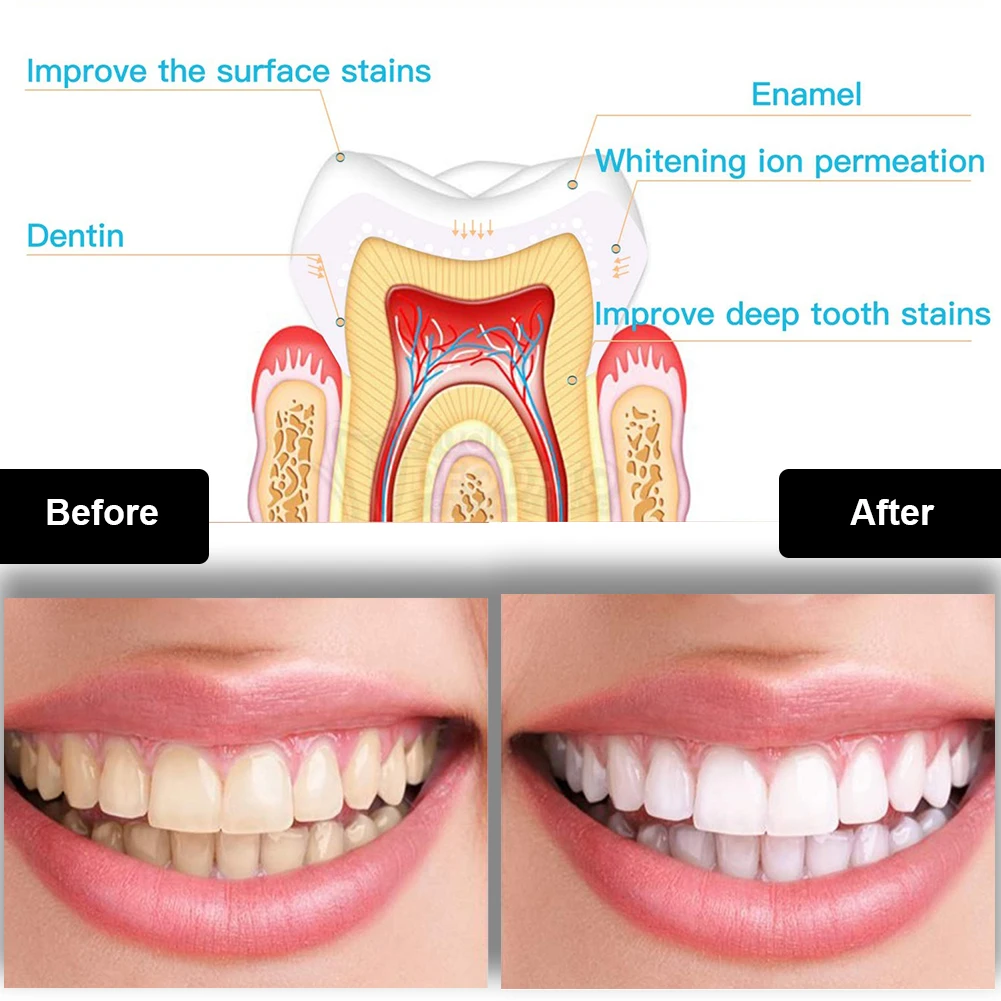 Kit de blanqueamiento Dental M - Teeth Whitening Blue Light reseña y precio